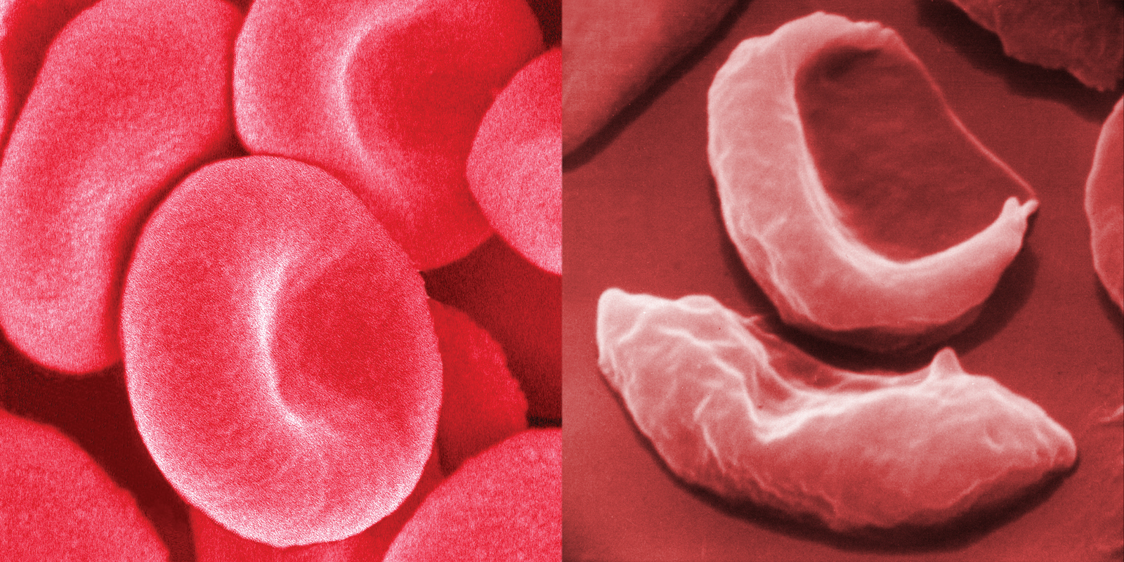 Vascarta Begins NIH Clinical Study of Topical Curcumin for Sickle Cell